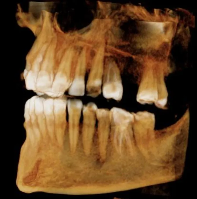 CBCT scan